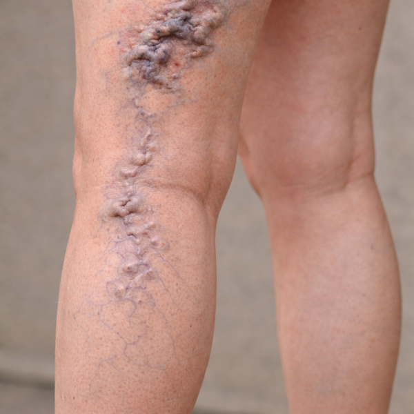 Detailed view of varicose veins