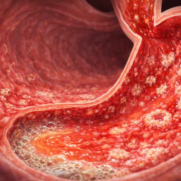 Inflamed stomach lining with ulcers