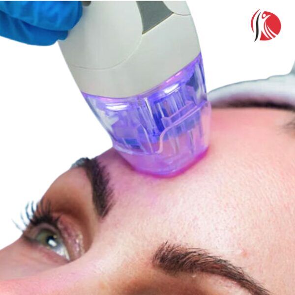 radiofrekvenčni-microneedling3